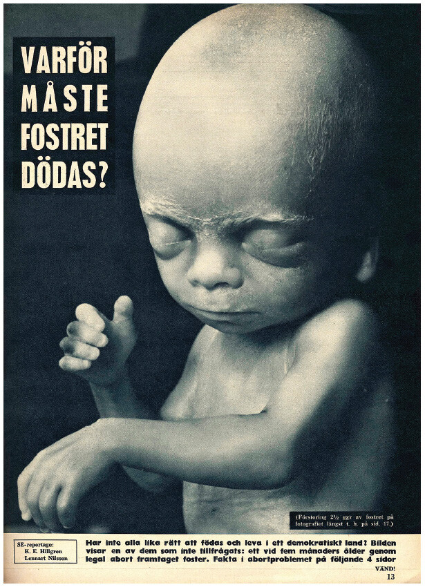 Five-months old fetus that was obtained through a legal abortion.