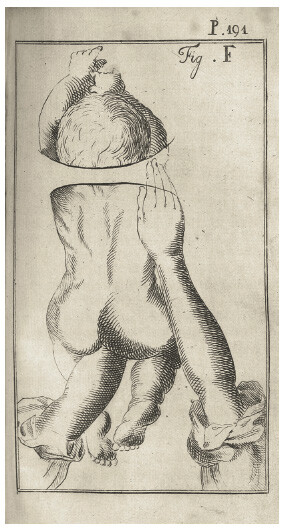 Instruction for assisting an infant who is born feet first. The birth practitioner is instructed to use their hands to help the babyâs arms and head pass through.