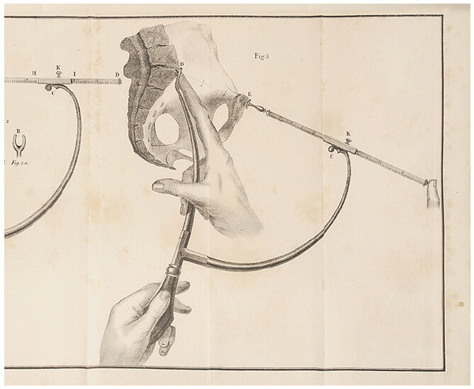 Instructional figure of how to use pelvimeters for measuring the pelvic canal.